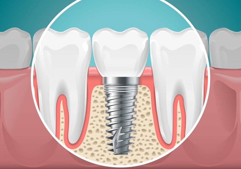Gülüş Akademisi dental implant tedavisi